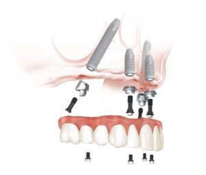 Illustration showing All-on-4® Treatment Concept - top arch
