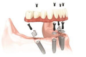 Illustration showing All-on-4® Treatment Concept - bottom arch